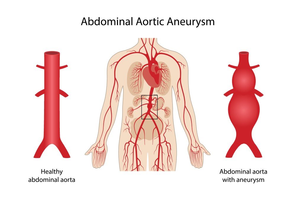 Abdominal Aortic Aneurysm