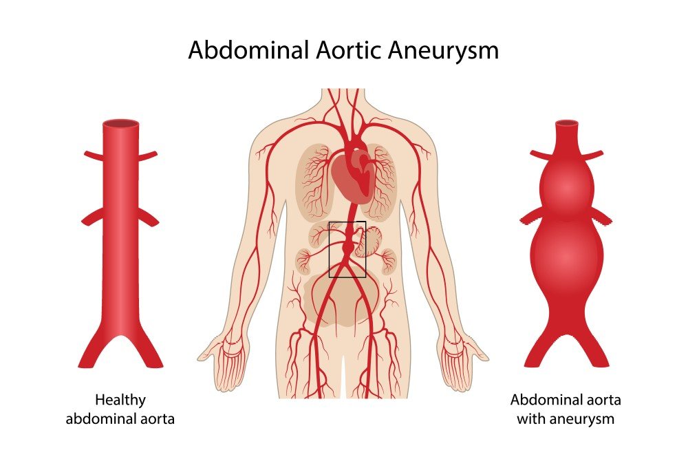 Abdominal Aortic Aneurysm In El Paso TX