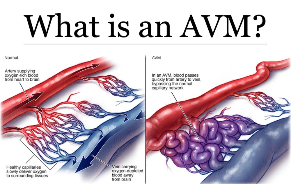 Arteriovenous Malformations