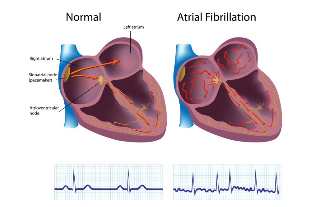 Atrial Fibrillation in El Paso, TX