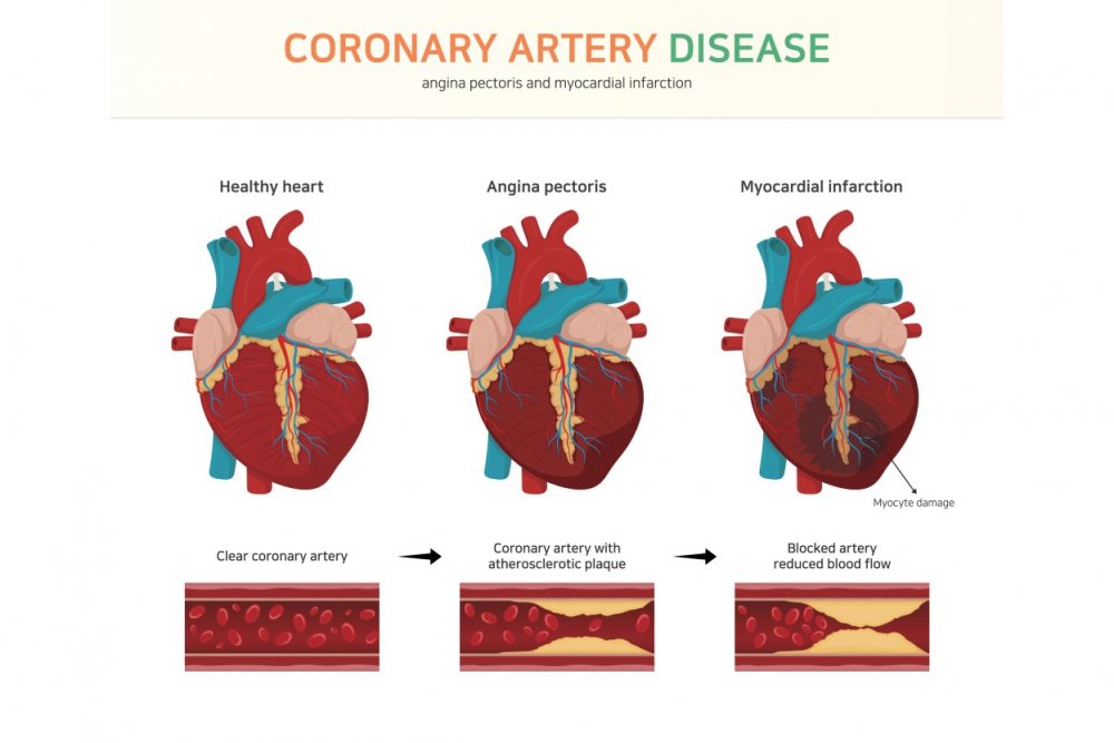 Coronary Artery Diagram For Patients