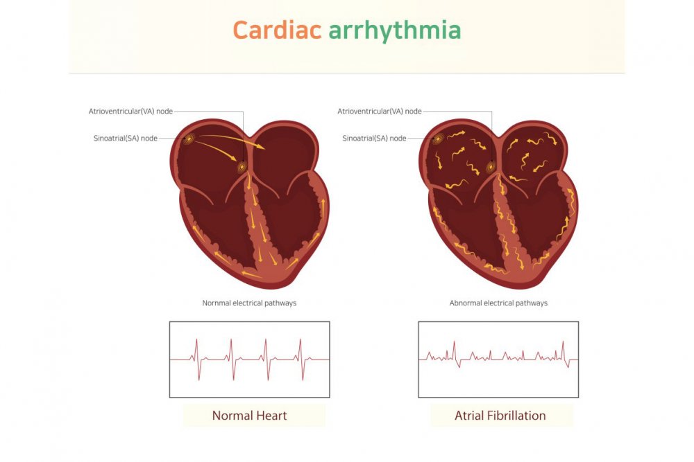 signs of heart arrhythmia