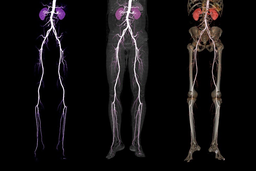 Peripheral Angiography