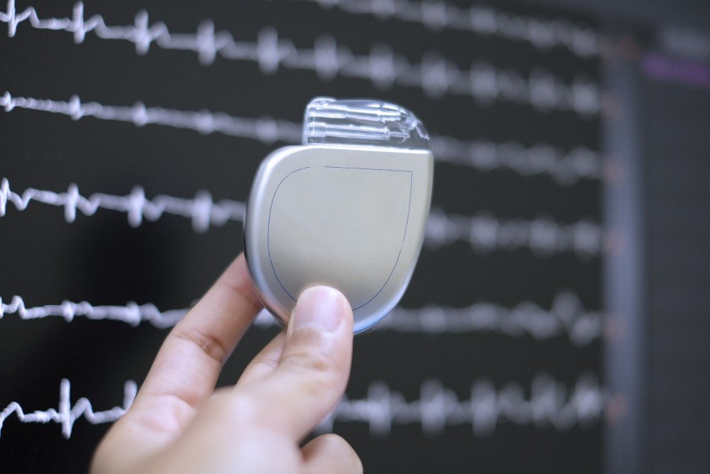 Permanent Pacemaker Implant