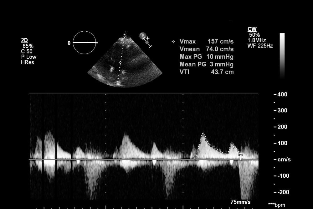 Transesophageal echocardiogram